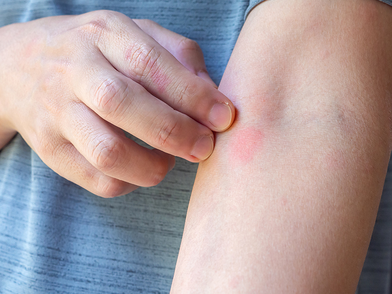 راهکارهای مقابله با نیش حشرات